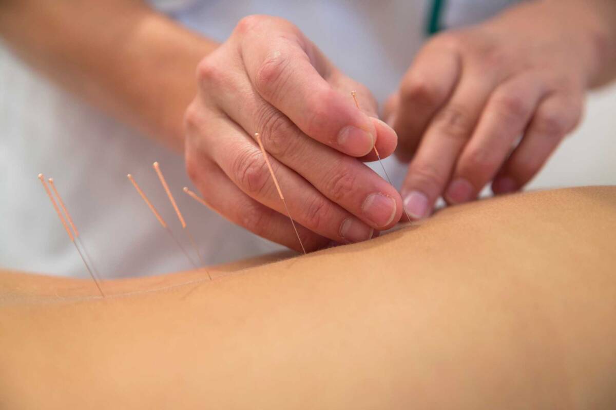 Quels sont les bienfaits de l&#8217;acupuncture pour les douleurs chroniques ? Freyming-Merlebach